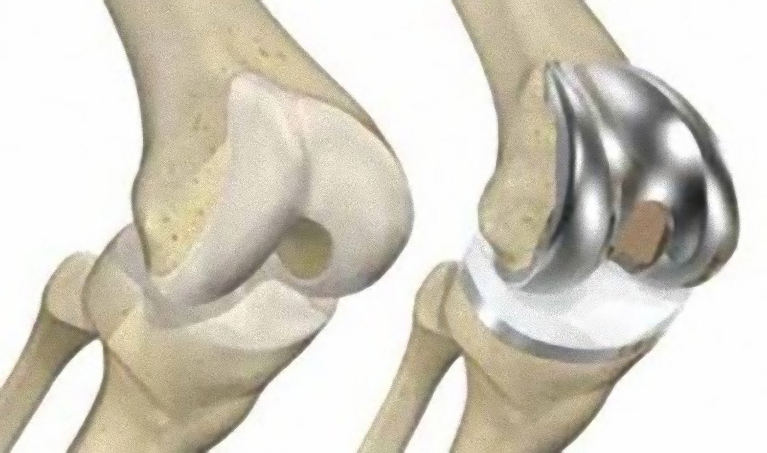 Сустав в воронеже купить. Артропластика коленного сустава. Maxx Orthopedic эндопротез коленного. Артропластика тазобедренного сустава. Тотальное эндопротезирование коленного сустава.